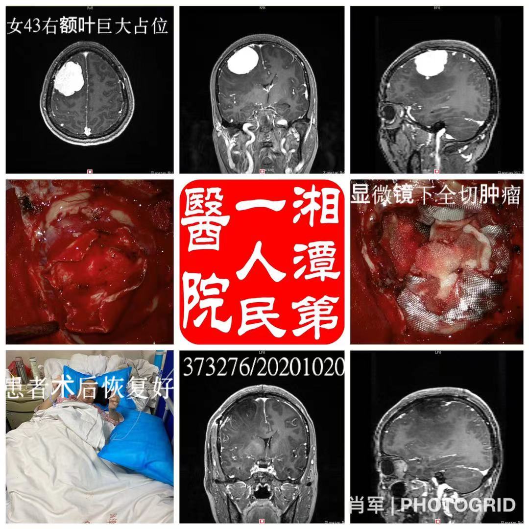 神外10月20日完成一例右额叶巨大占位显微镜下全切术,手术顺利,术
