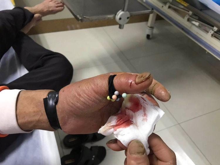 此患者在菜地里被不明蛇咬伤大拇指,后在家里做了简单处理.