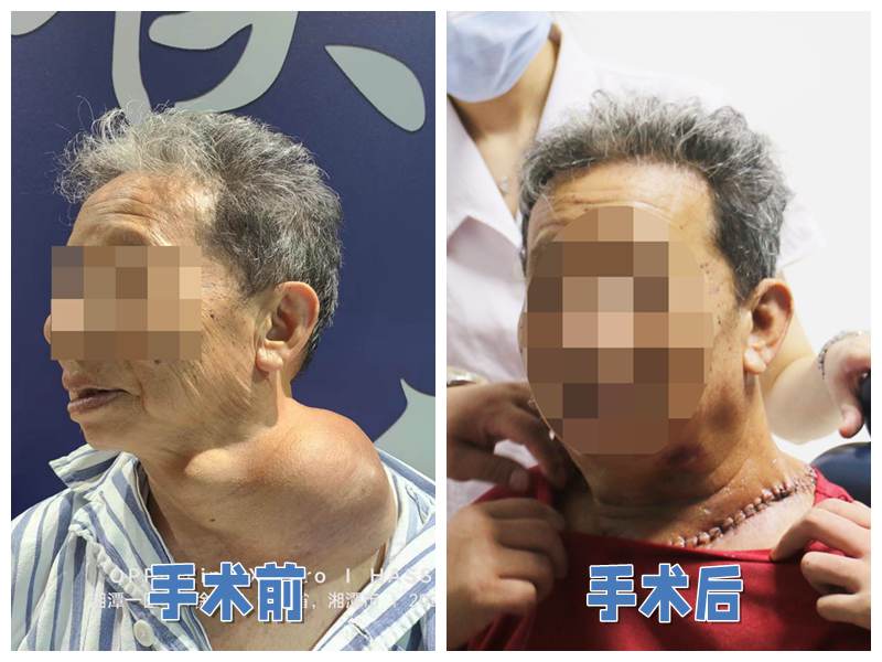 【医者红】医者匠心｜耳鼻咽喉科成功完成七旬老人巨大甲状腺肿瘤切除术